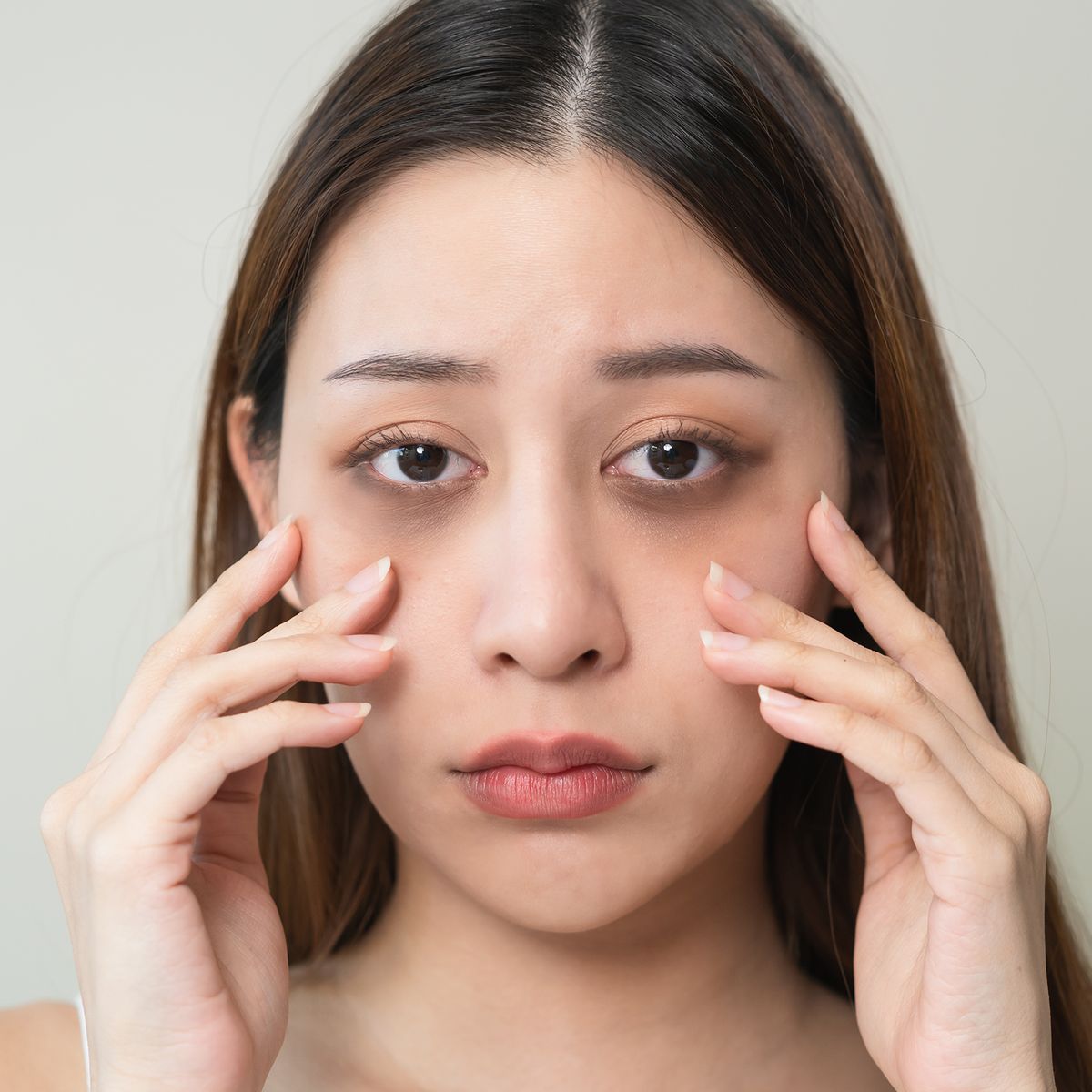 Dark Circles: Causes and Effective Treatments
