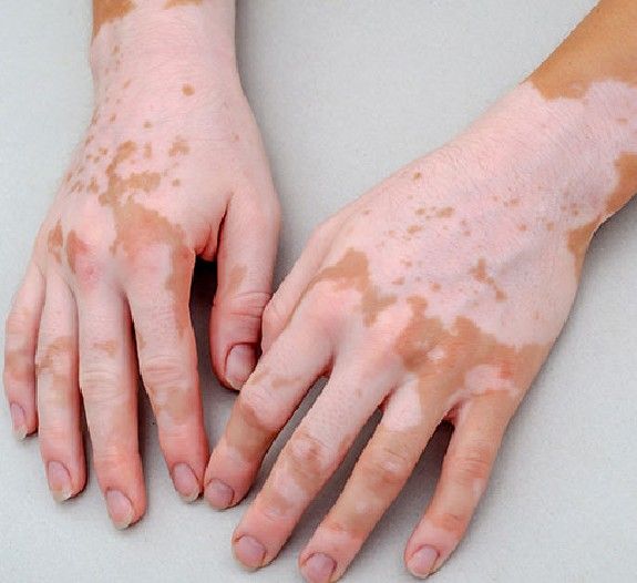 Vitiligo: Causes, Symptoms, and Treatment Options