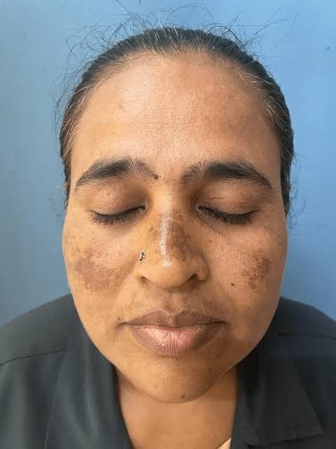 Melasma in Indian Skin: Why It Happens and How to Treat It