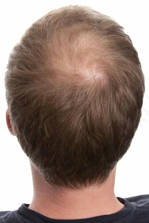 Hair Fall in Men & Women: Causes and Modern Treatment Options