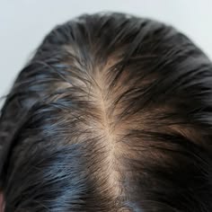 Hair Fall & Hair Thinning