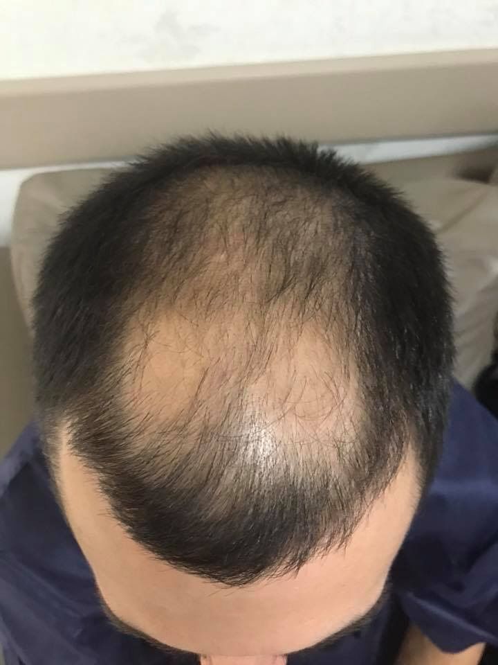 Male Pattern Hair Loss