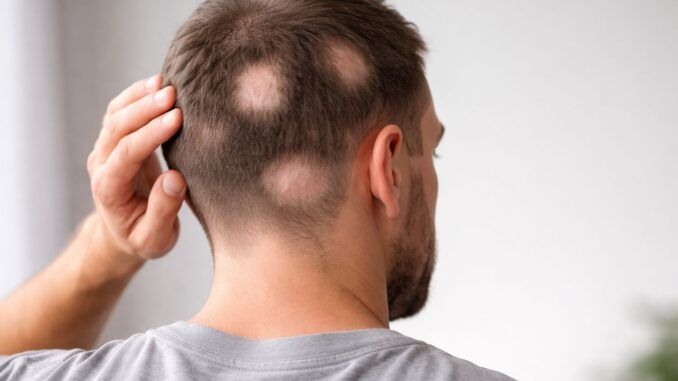 Alopecia Areata