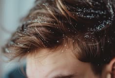 Dandruff & Seborrhoeic Dermatitis