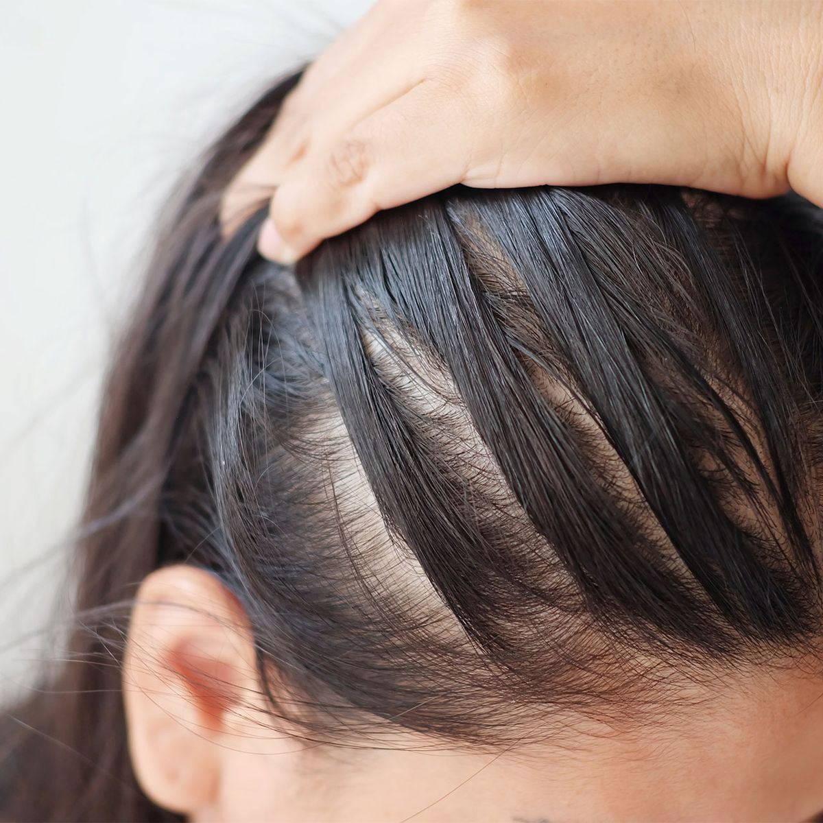 Scalp Disorders