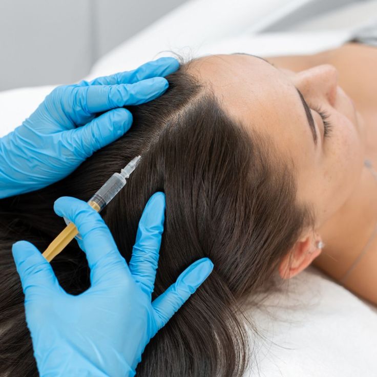 PRP for Hair Loss