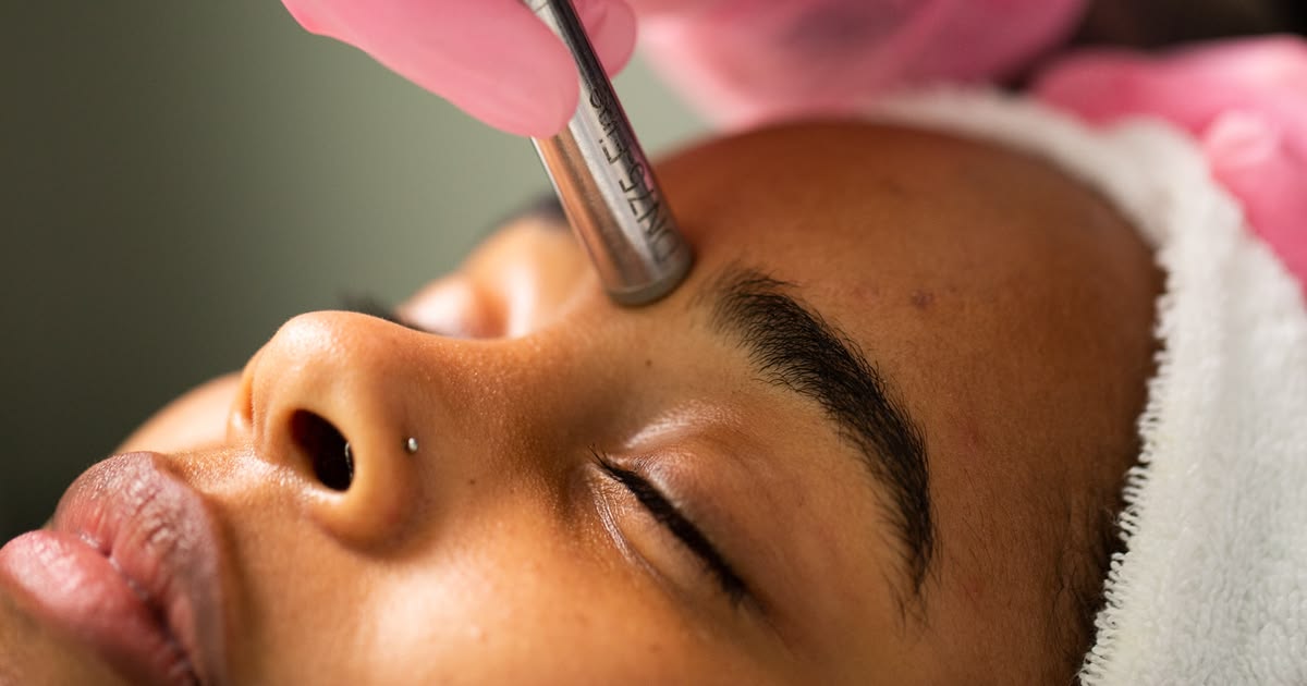Microneedling