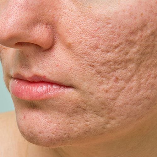 Acne Scar Treatment