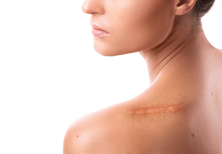 Chemical Reconstruction of Skin Scars (TCA CROSS)