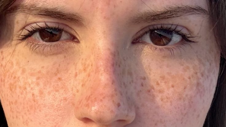 Freckles