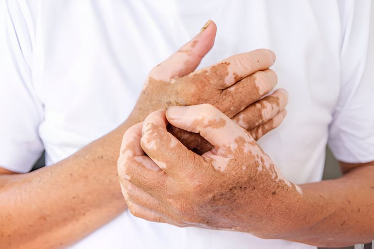 Excimer Laser for Vitiligo
