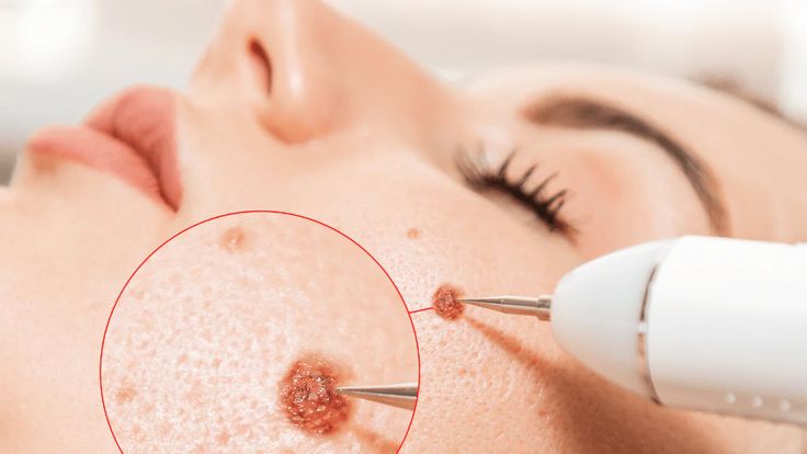 Mole Removal