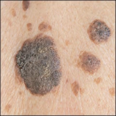 Skin Tag Removal