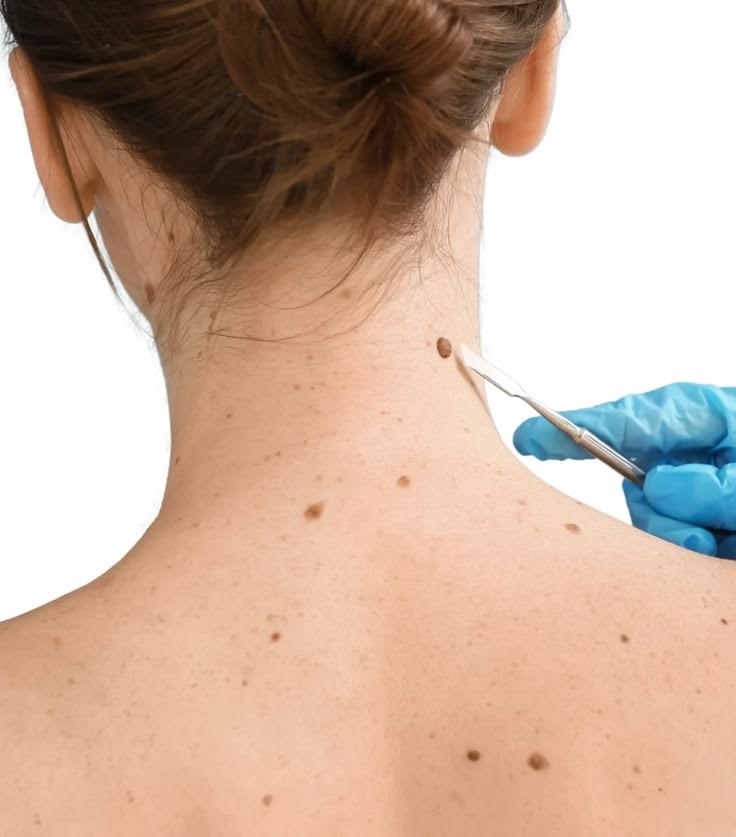 Wart Removal