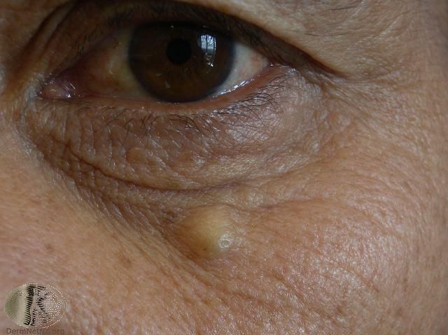 Sebaceous Cyst Management