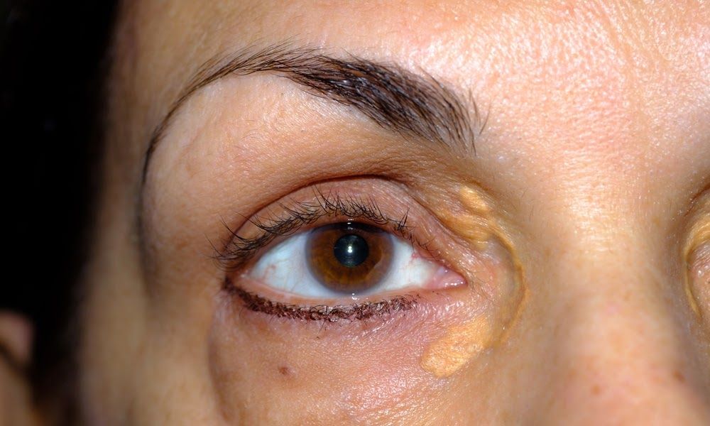 Xanthelasma Treatment