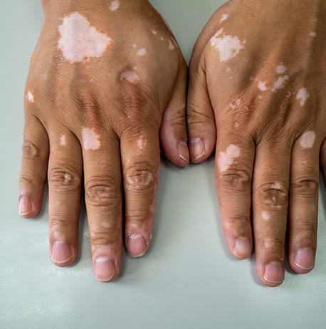 Vitiligo Medical Management
